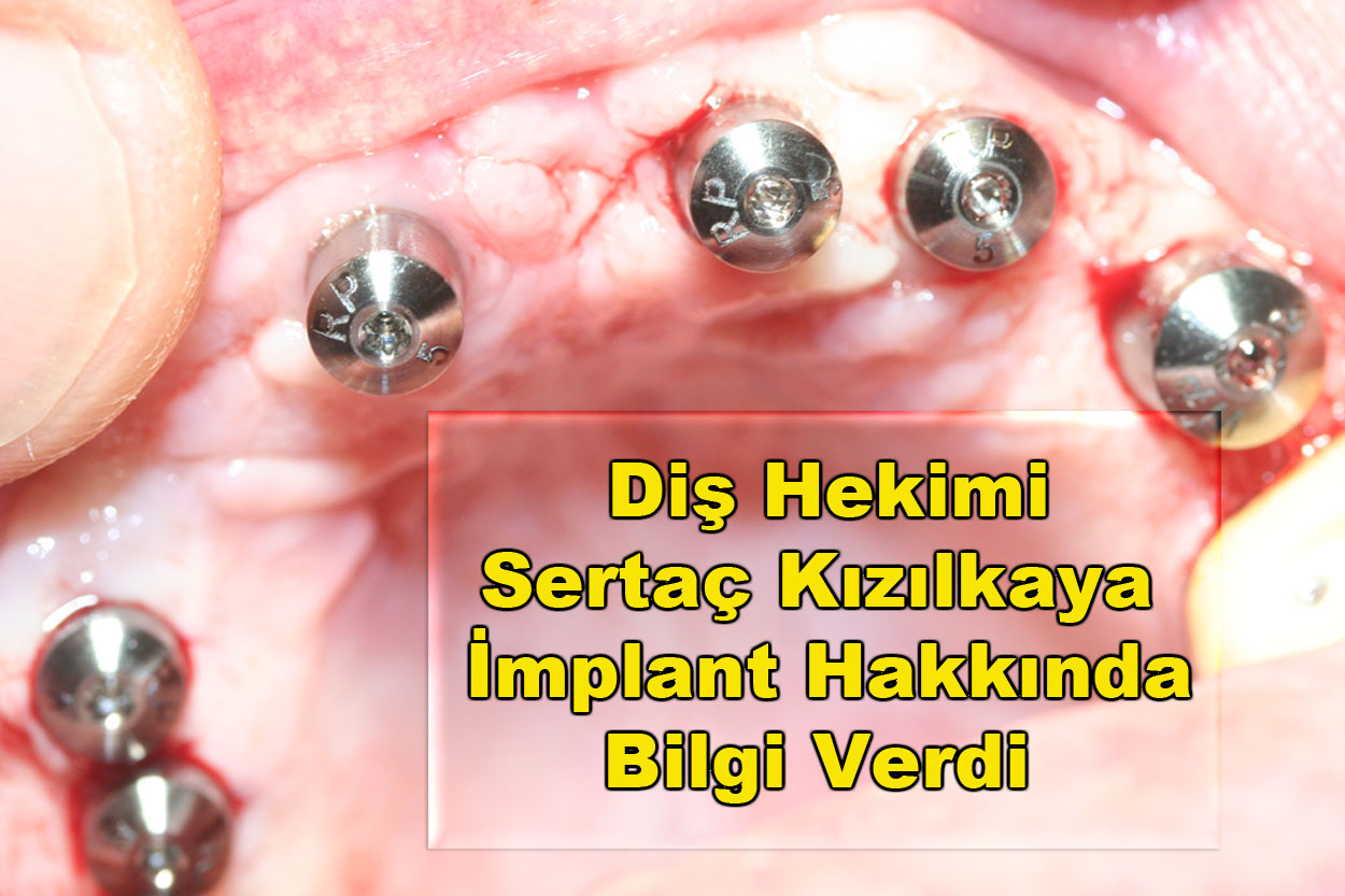 Tek diş implant