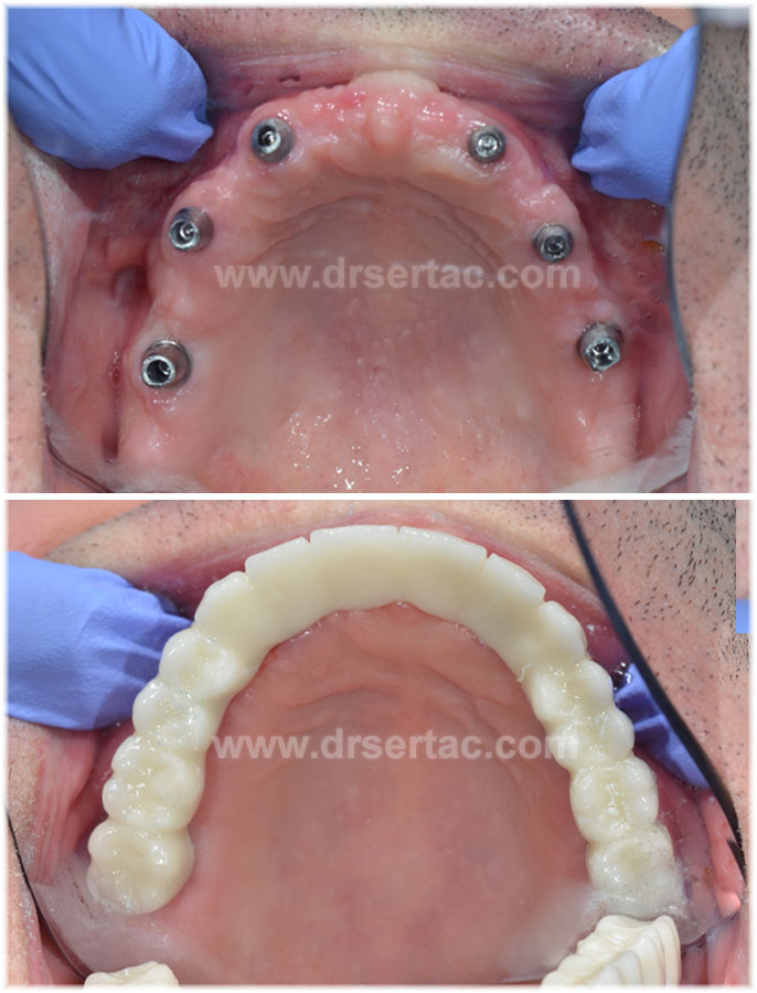 İmplant üzeri zirkonyum ve ya porselen diş köprüsü yapılabildiği gibi hareketli diş protezi de yapılabilir.