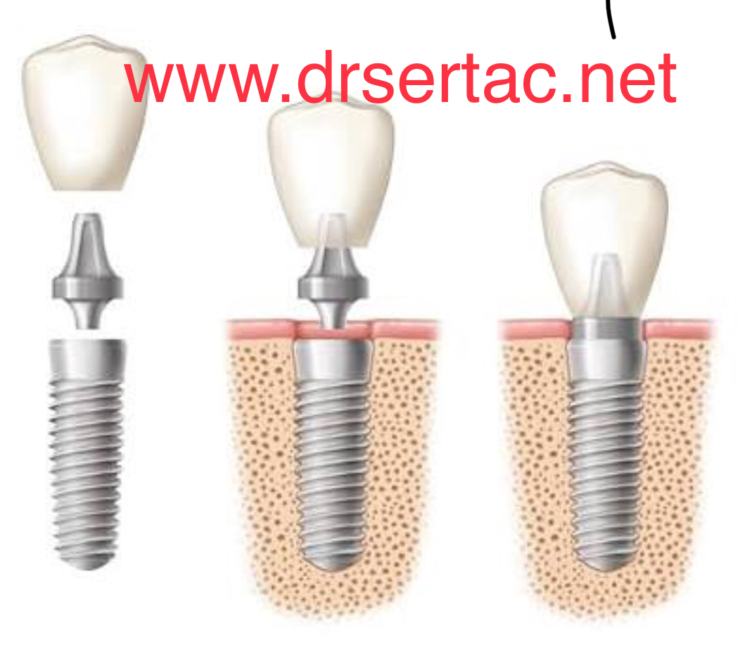 implant fiyatları