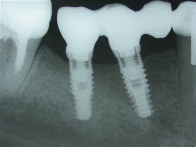 Nucleoss implant